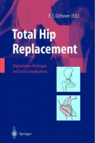 Carte Total Hip Replacement P. E. Ochsner