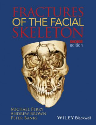 Livre Fractures of the Facial Skeleton 2e Michael Perry