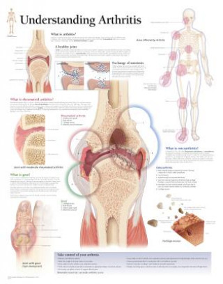 Prasa Understanding Arthritis Laminated Poster Scientific Publishing