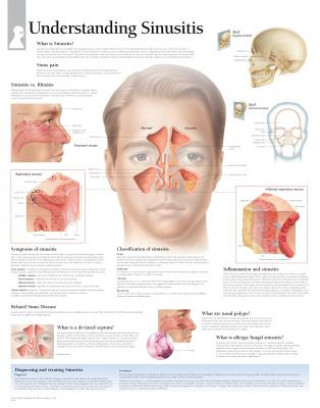 Nyomtatványok Understanding Sinusitis Laminated Poster Scientific Publishing