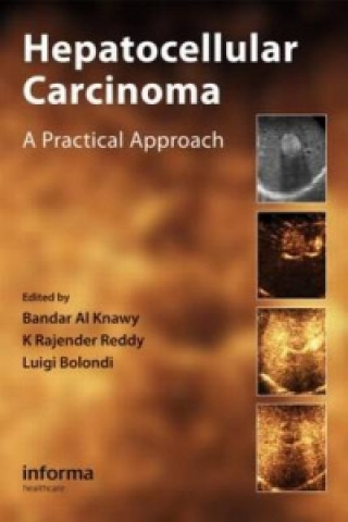 Buch Hepatocellular Carcinoma Bandar Al Knawy