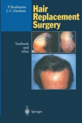 Książka Hair Replacement Surgery J. C. Dardour