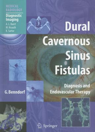 Könyv Dural Cavernous Sinus Fistulas Goetz Benndorf