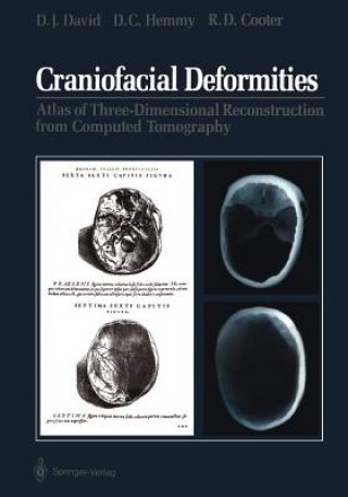 Kniha Craniofacial Deformities Rodney D. Cooter