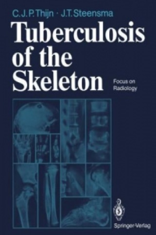 Carte Tuberculosis of the Skeleton Jieldouw T. Steensma