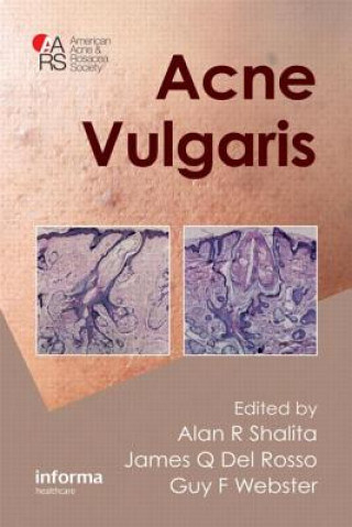 Książka Acne Vulgaris 