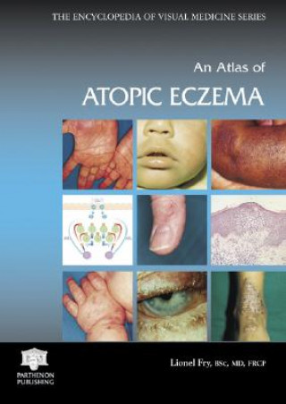 Kniha Atlas of Atopic Eczema Lionel Fry