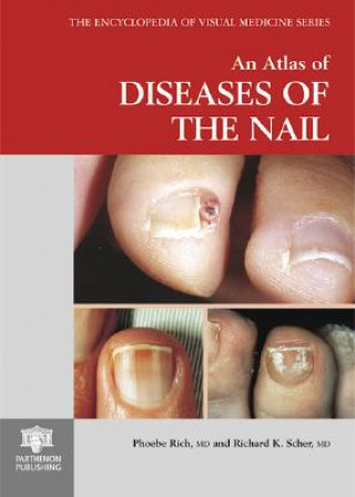 Carte Atlas of Diseases of the Nail Phoebe A. Rich