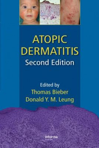 Buch Atopic Dermatitis Thomas Bieber