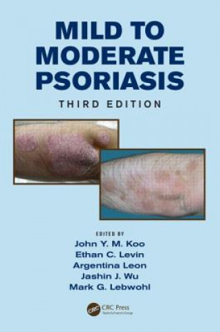 Könyv Mild to Moderate Psoriasis John Y. M. Koo