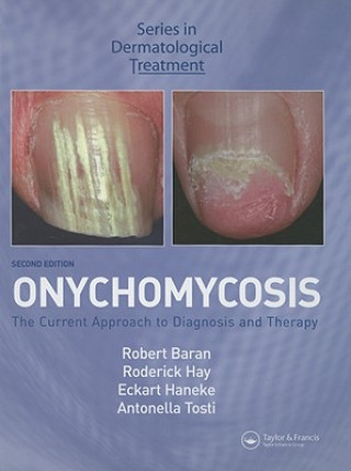 Könyv Onychomycosis Robert Baran