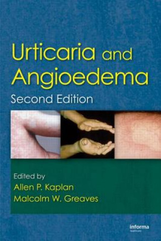 Könyv Urticaria and Angioedema 