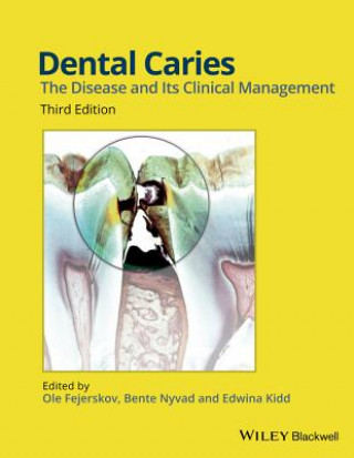 Kniha Dental Caries 3e Ole Fejerskov