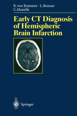 Kniha Early CT Diagnosis of Hemispheric Brain Infarction Rüdiger von Kummer