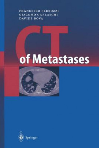 Carte CT of Metastases Francesco Ferrozzi