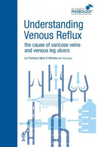 Kniha Understanding Venous Reflux the Cause of Varicose Veins and Venous Leg Ulcers Mark S. Whiteley