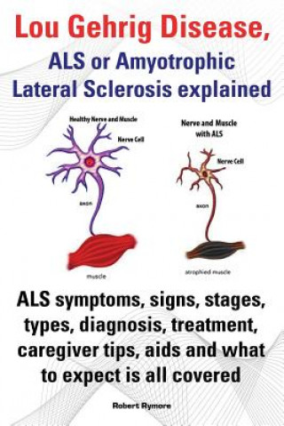 Książka Lou Gehrig Disease, ALS or Amyotrophic Lateral Sclerosis explained. ALS symptoms, signs, stages, types, diagnosis, treatment, caregiver tips, aids and Robert Rymore