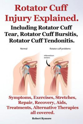 Knjiga Rotator Cuff Injury Explained. Including Rotator Cuff Tear, Rotator Cuff Bursitis, Rotator Cuff Tendonitis. Symptoms, Exercises, Stretches, Repair, Re Robert Rymore