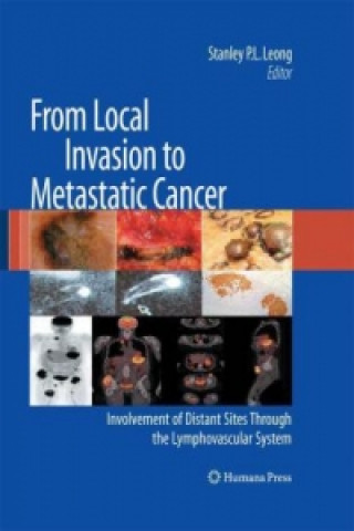 Kniha From Local Invasion to Metastatic Cancer Stanley P. L. Leong