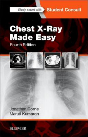 Carte Chest X-Ray Made Easy Jonathan Corne