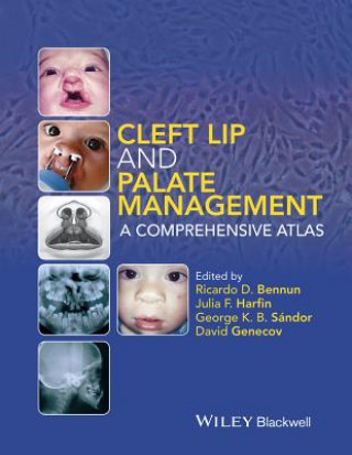 Książka Cleft Lip and Palate Management David Genecov