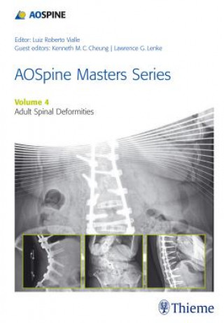 Carte AOSpine Master Series - Adult Spinal Deformities Lawrence G. Lenke
