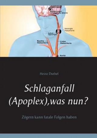 Книга Schlaganfall (Apoplex), was nun? Heinz Duthel