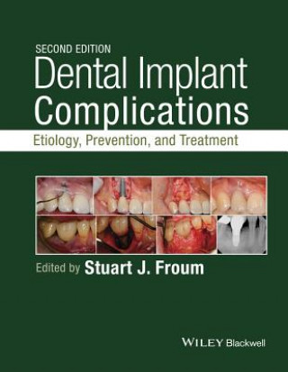 Könyv Dental Implant Complications - Etiology, , and Treatment, Second Edition Stuart Froum