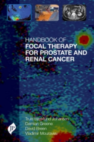 Książka Handbook of Focal Therapy for Prostate and Renal Cancer Truls E. Bjerklund Johansen