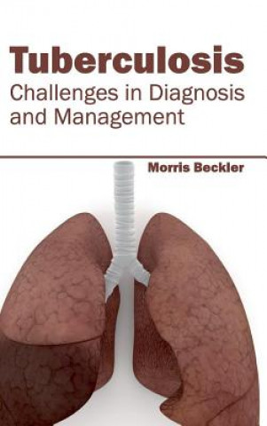 Knjiga Tuberculosis: Challenges in Diagnosis and Management Morris Beckler