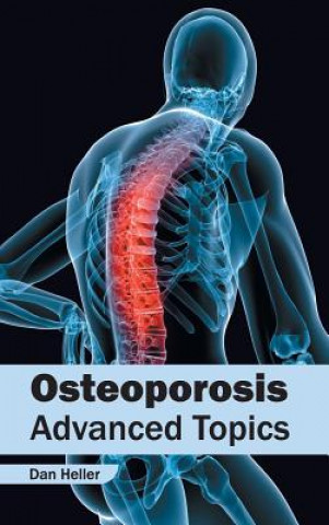 Книга Osteoporosis: Advanced Topics Dan Heller