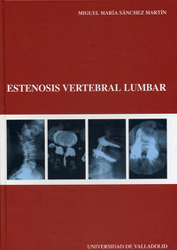 Kniha Estenosis vertebral lumbar Miguel María Sánchez Martín