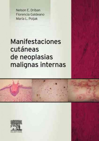 Carte Manifestaciones cutáneas de neoplasias malignas internas 