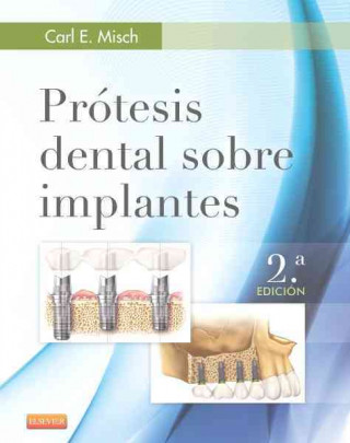 Kniha Prótesis dental sobre implantes C.E. MISCH