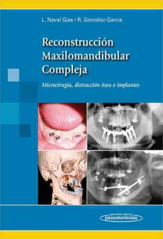 Carte Reconstrucción maxilomandibular compleja Luis Naval Gías