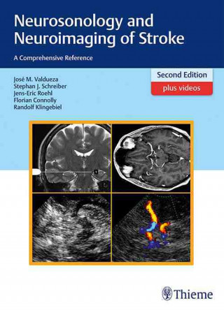 Книга Neurosonology and Neuroimaging of Stroke José Manuel Valdueza