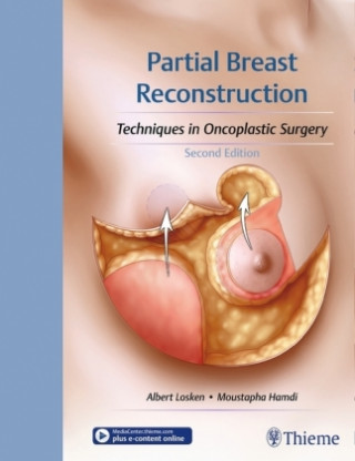 Carte Partial Breast Reconstruction Albert Losken