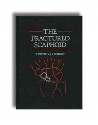 Carte Fractured Scaphoid Timothy J. Herbert