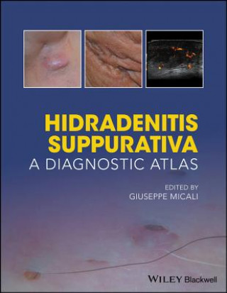 Könyv Hidradenitis Suppurativa - A Diagnostic Atlas Giuseppe Micali