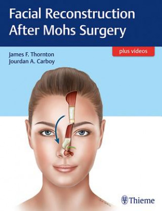 Kniha Facial Reconstruction After Mohs Surgery James F. Thornton