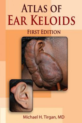 Książka Atlas of Ear Keloids Michael H Tirgan MD