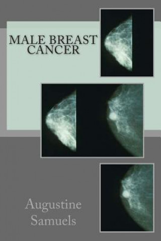 Buch Male Breast Cancer Augustine Samuels Ma