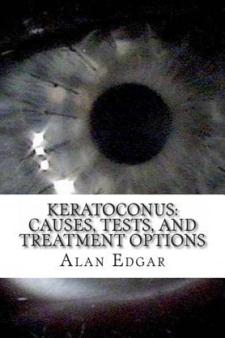 Libro Keratoconus: Causes, Tests, and Treatment Options Alan Edgar Ma