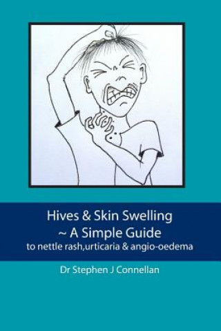 Könyv Hives & Skin Swelling A Simple Guide: to nettle rash, urticaria & angio-oedema Dr Stephen J Connellan