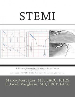 Knjiga Stemi: 3-Minute Diagnosis, 90-Minute Reperfusion: Saving Time, Saves Lives Marco a Mercader MD