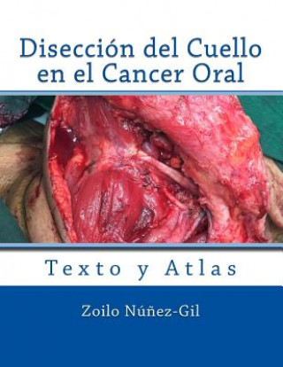 Kniha Diseccion del Cuello en el Cancer Oral Dr Zoilo Nunez-Gil