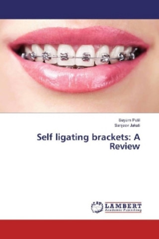Buch Self ligating brackets: A Review Sayam Patil