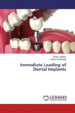 Carte Immediate Loading of Dental Implants Vishal Tapadiya
