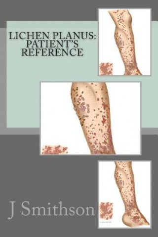 Kniha Lichen Planus: Patient's Reference J P Smithson Ma