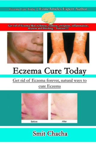 Книга Eczema Cure Today - Get rid of Eczema forever natural ways to cure Eczema SMIT CHACHA